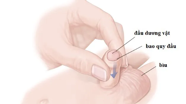 Nong bao quy đầu cho bé trai: giải pháp đơn giản và hiệu quả