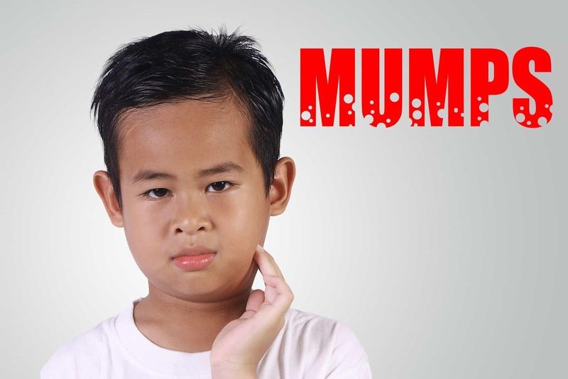 Bệnh quai bị ở trẻ em: nguyên nhân, triệu chứng và biến chứng