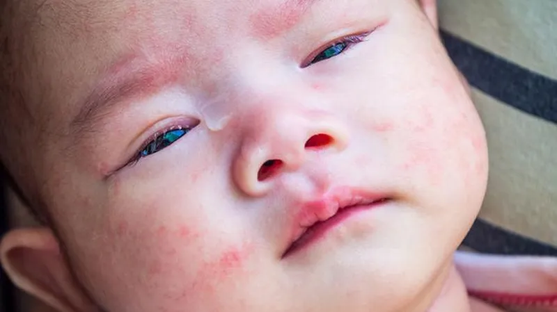 Trẻ phát ban đỏ sau 3 ngày sốt: nguyên nhân, bệnh lý và cách chăm sóc