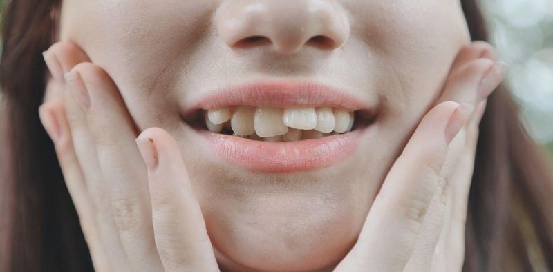 Răng mọc chồi: tình trạng, tác động và cách khắc phục