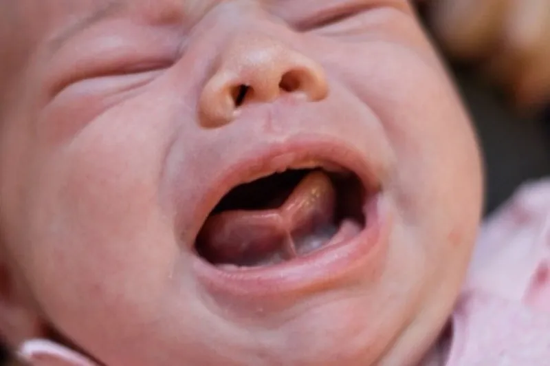 Phẫu thuật cắt thắng lưỡi - giải pháp cho trẻ dính thắng lưỡi