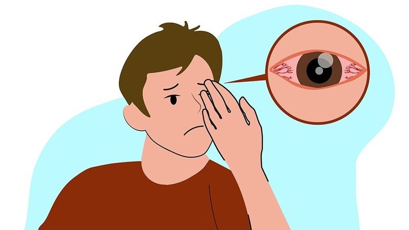 Viêm giác mạc dùng thuốc gì? tìm hiểu về những loại thuốc điều trị viêm giác mạc