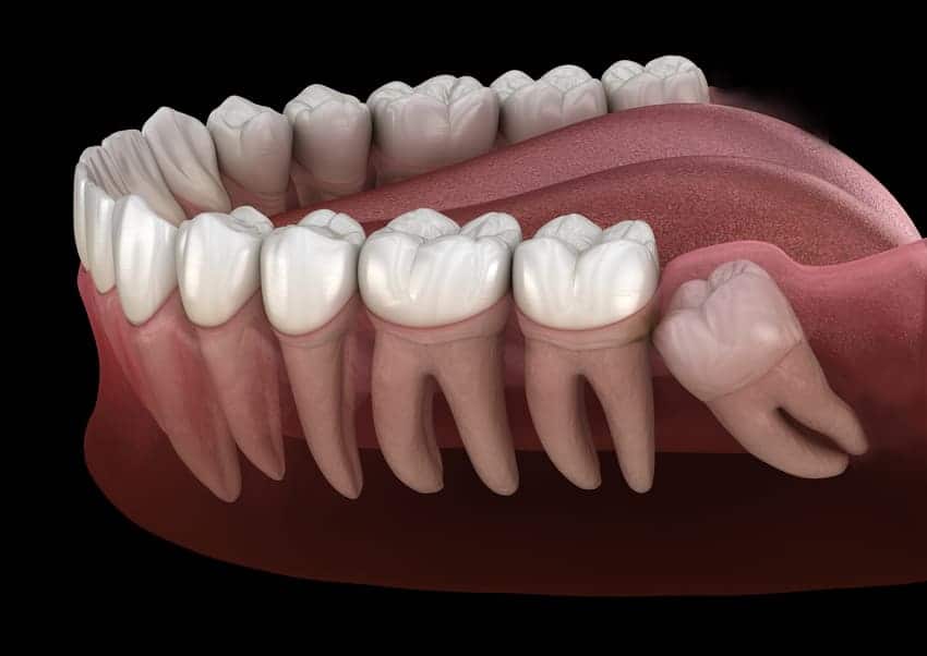 Nhổ răng khôn có nguy hiểm không? Quy trình và lưu ý phải biết