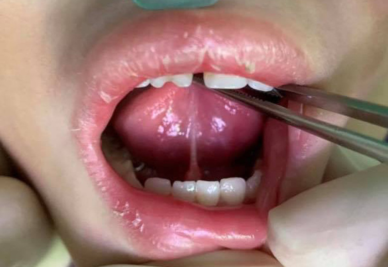 Dính thắng lưỡi - nguyên nhân khiến trẻ chậm nói - Đài Phát thanh và Truyền  hình Điện Biên
