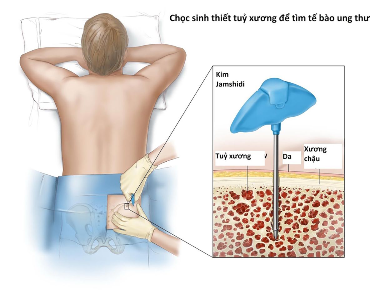 Kết quả sinh thiết có chính xác không? Xem ngay câu trả lời