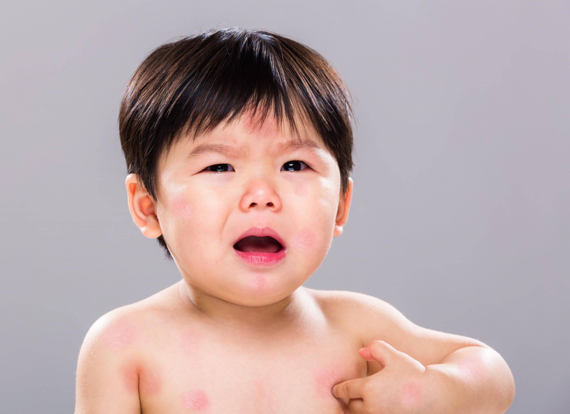 Dị Ứng Đạm Sữa Bò Là Gì? Nguyên Nhân, Triệu Chứng Và Cách Xử Lý