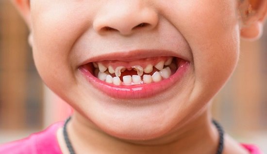 Những vấn đề về sức khỏe răng miệng thường gặp ở trẻ nhỏ - nhakhoathuyanh