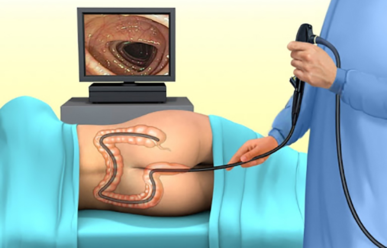 CHI TIẾT] 4 BƯỚC CỦA QUY TRÌNH NỘI SOI ĐẠI TRÀNG
