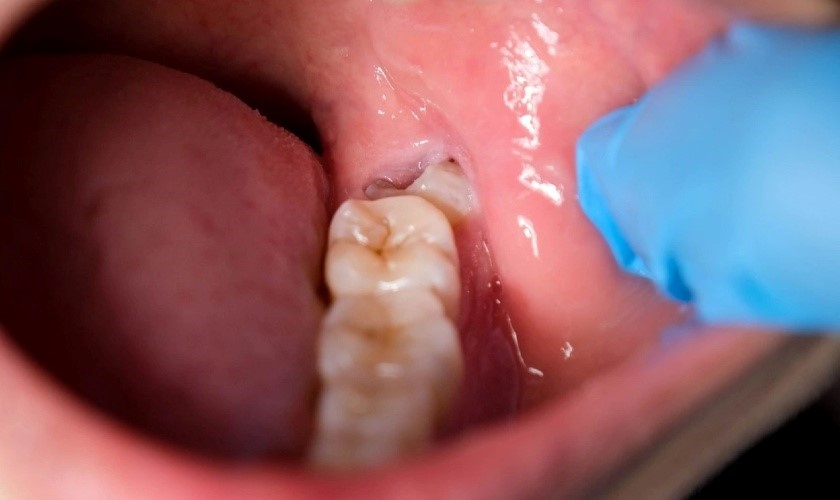 Dấu Hiệu Răng Khôn Mọc Lệch Hàm Dưới? Có Nên Nhổ Không?