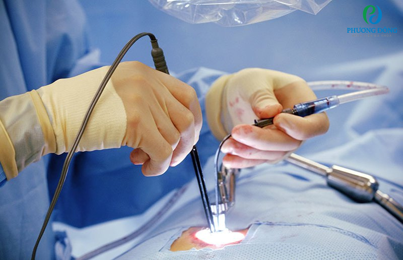 Kết quả giải phẫu bệnh từ mẫu sinh thiết giúp xác định bản chất lành tính hay ác tính của khối u