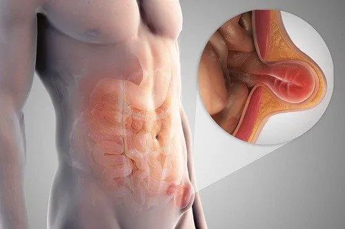 Sờ thấy khối u ở bụng là dấu hiệu bệnh gì?