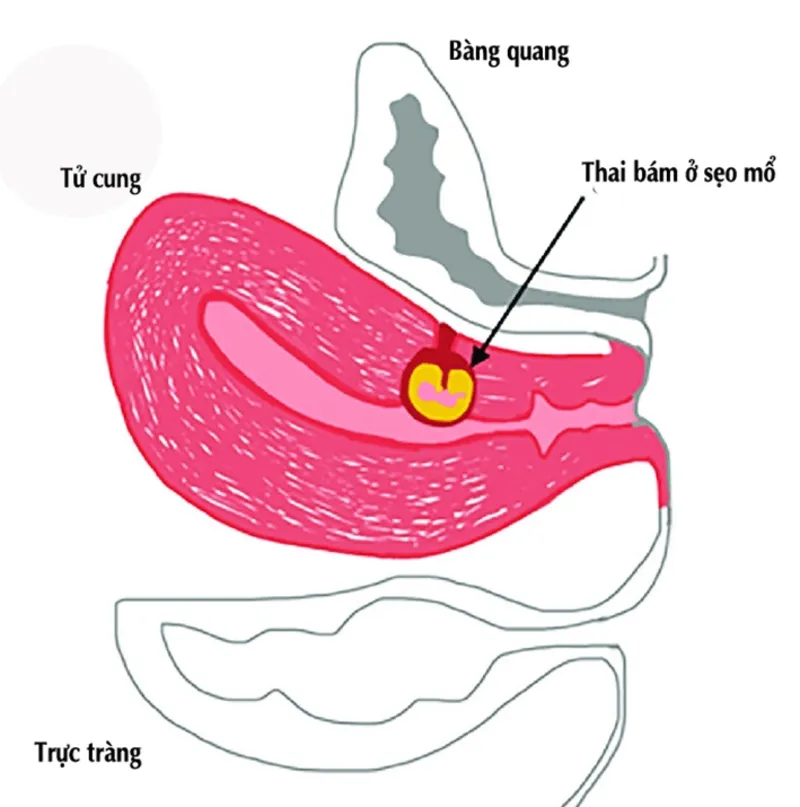 Thai bám vào vết mổ tử cung là gì?