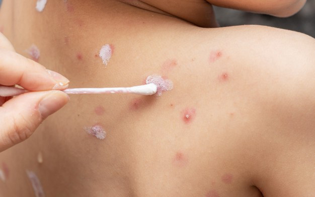 Chăm sóc trẻ bị thủy đậu đúng cách và những sai lầm thường gặp