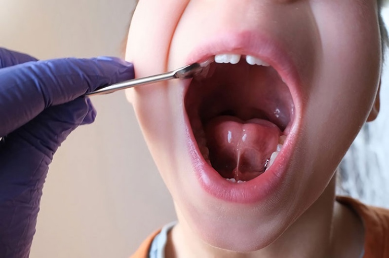 Trẻ bị dính thắng lưỡi chậm nói và giải pháp xử lý