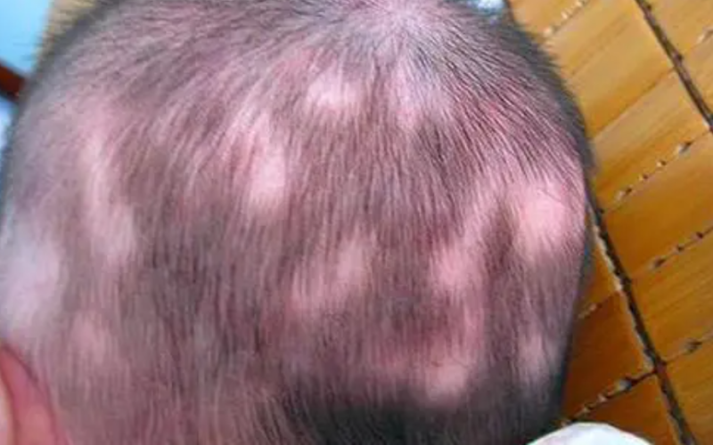 Nguyên nhân trẻ sơ sinh bị rụng tóc nhiều và cách xử lý