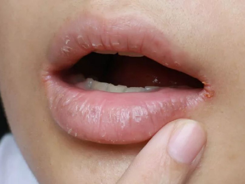 Trẻ bị khô môi thiếu chất gì? Cách khắc phục hiệu quả nhất
