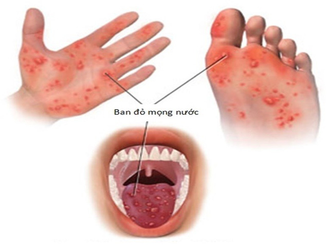 Dấu hiệu nhận biết sớm trẻ mắc bệnh tay chân miệng - BỆNH VIỆN BỆNH NHIỆT  ĐỚI