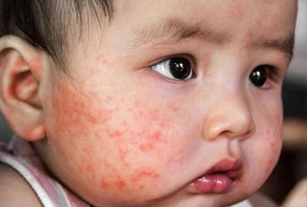 Nguyên nhân gây dị ứng thời tiết ở trẻ và cách chăm sóc