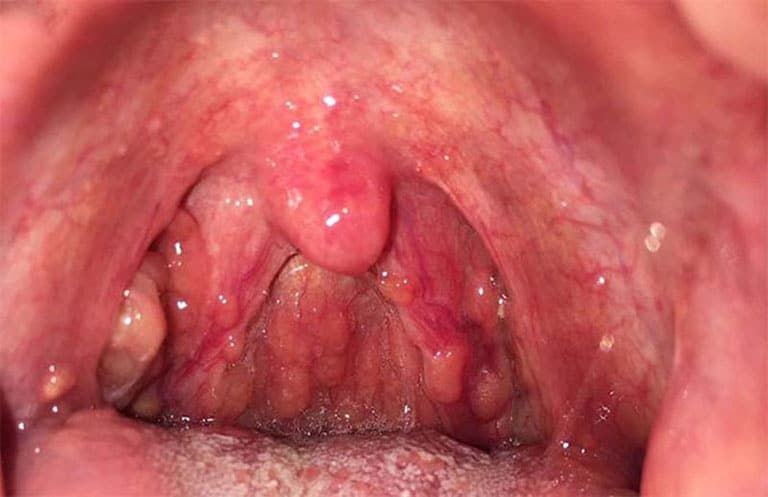 Viêm họng hạt ở trẻ em