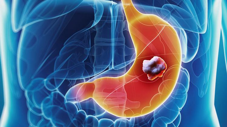 Ung thư dạ dày: nguy hiểm và cách phòng ngừa