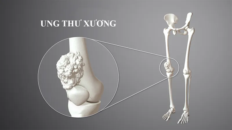 Chẩn đoán hình ảnh hiện đại giúp phát hiện sớm các tổn thương ác tính trong xương