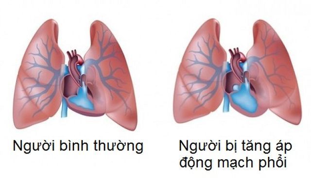 Tất tần tật về tăng áp phổi: nguyên nhân||||Tất tần tật về tăng áp phổi: nguyên nhân