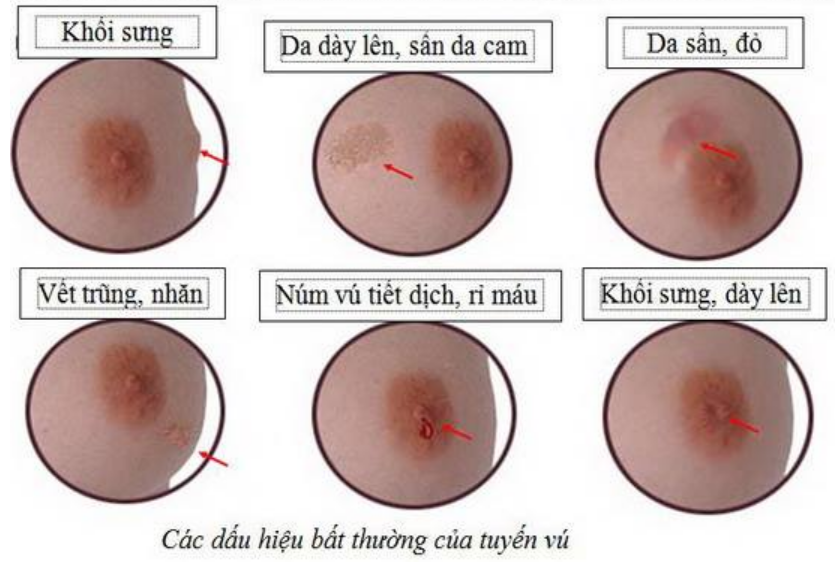 Triệu chứng của ung thư vú