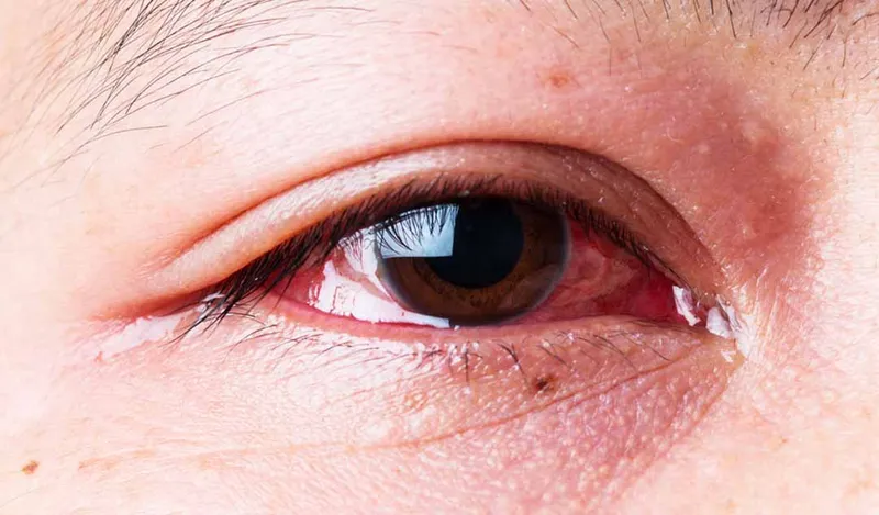 Tình trạng mờ mắt đột ngột không đau đớn cảnh báo mạch máu võng mạc đang bị bít tắc cấp tính
