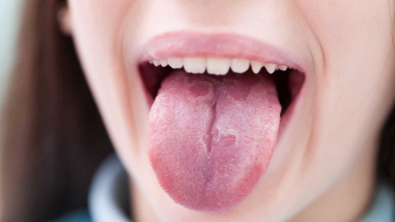Các giai đoạn ung thư miệng ( Nguồn: sưu tầm )