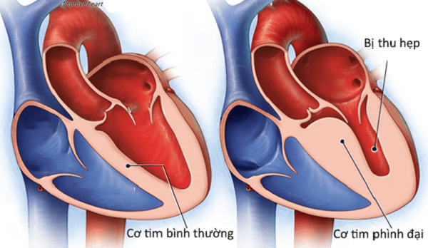 Bệnh cơ tim phì đại là bệnh tương đối hiếm gặp