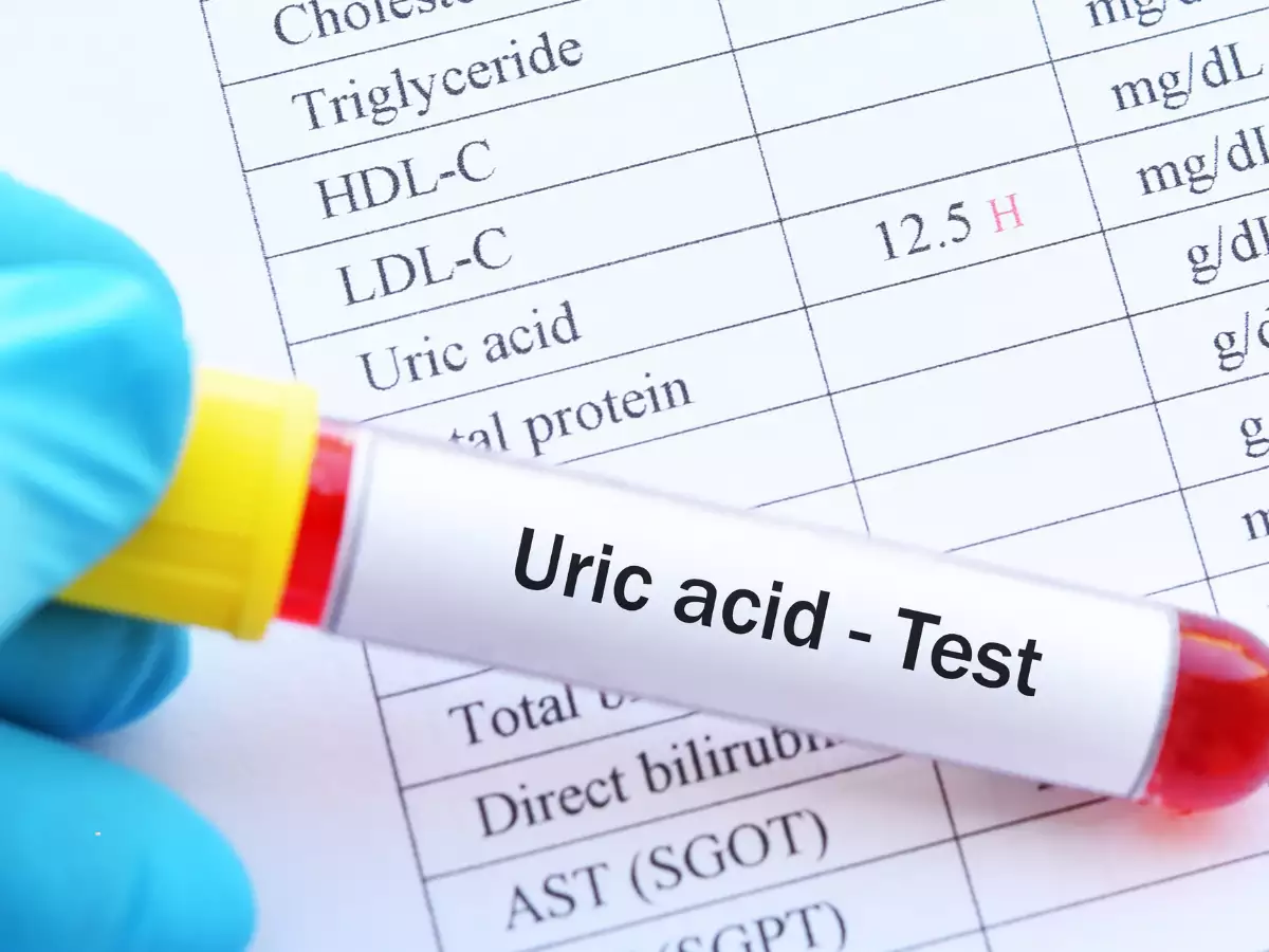 Tăng acid uric máu là gì?