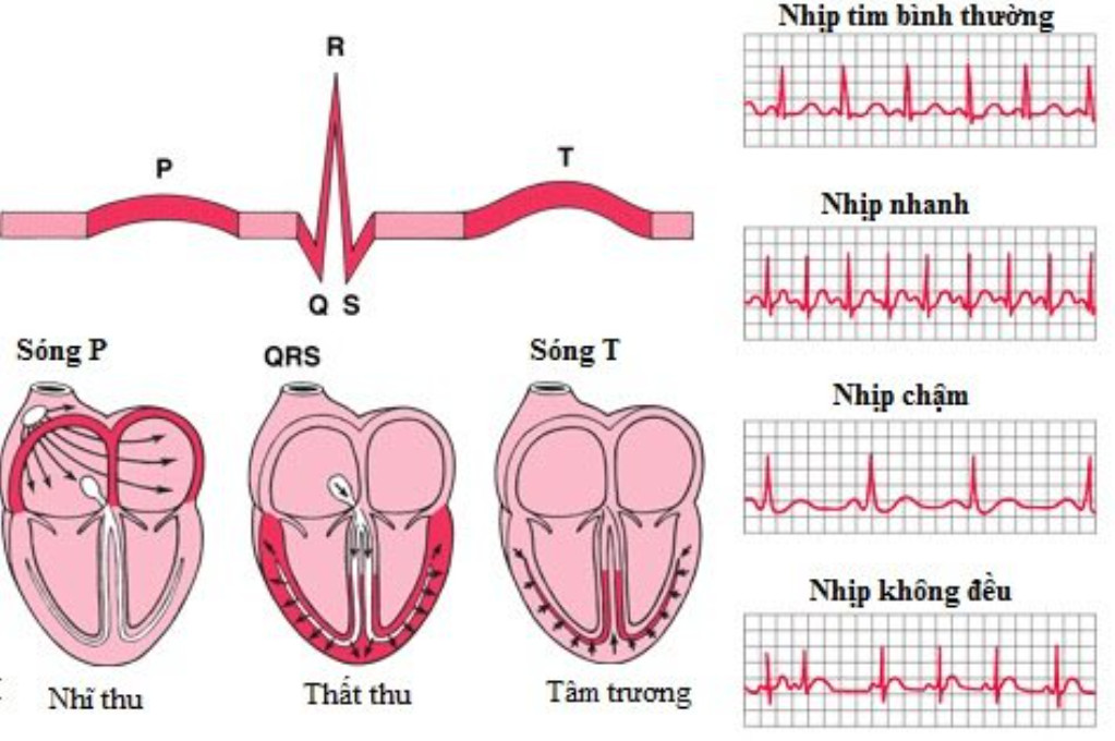 Các biểu hiện đặc trưng của rối loạn nhịp tim