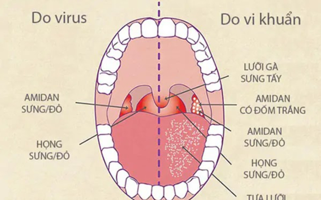 Vi khuẩn, virus là nguyên nhân gây viêm amidan