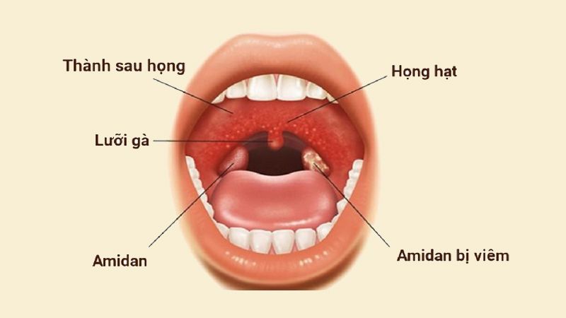 Tìm hiểu về viêm họng hạt||||Tìm hiểu về viêm họng hạt: bệnh lý phổ biến