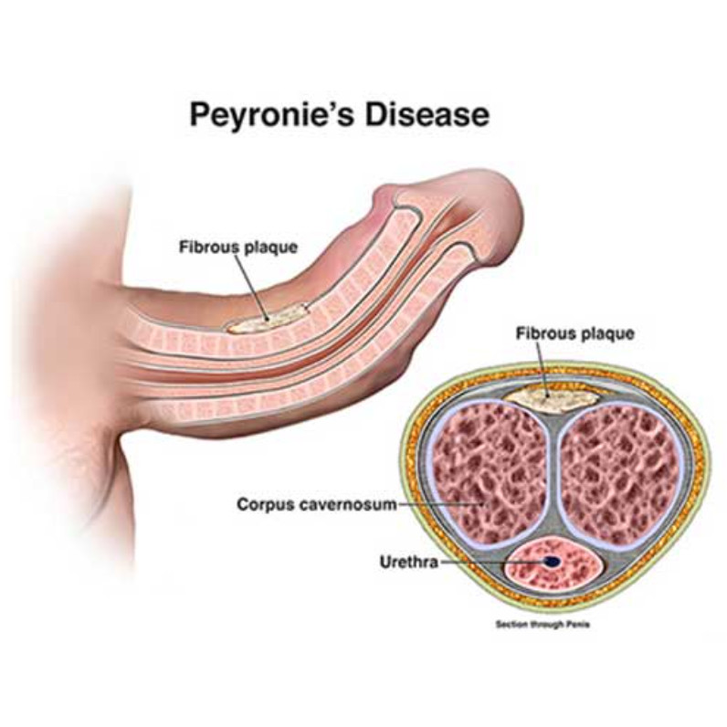 Bệnh Peyronie hay còn gọi bệnh dương vật cong