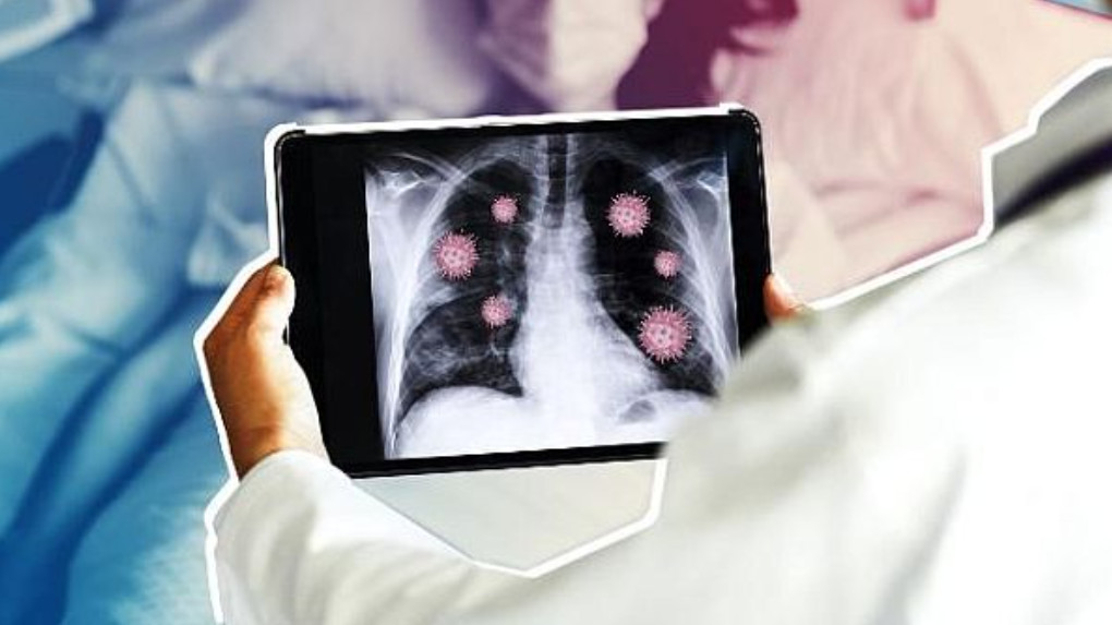 Chuẩn đoán viêm phổi do virus