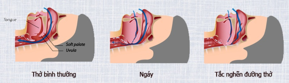 Mô tả đường thở khi ngủ ngáy