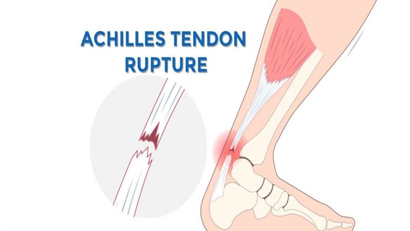 Gân Achilles nằm ở phía sau cổ chân và nối cơ bắp chân với xương gót