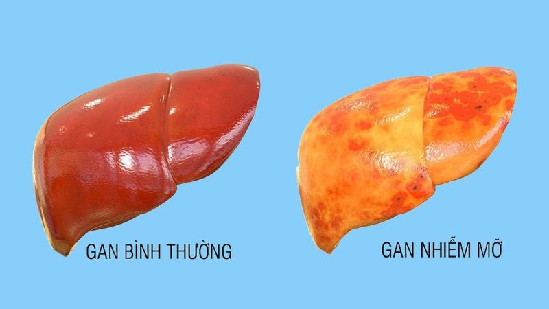 Chẩn đoán bằng hình ảnh giúp xác định chính xác giai đoạn nhiễm mỡ 