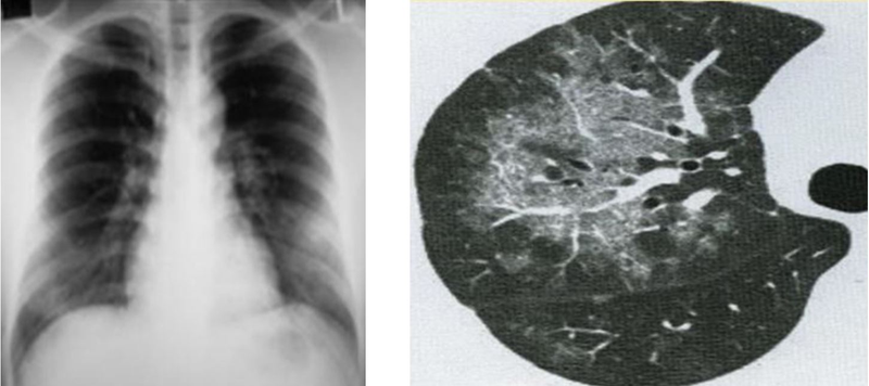 Chụp CT cung cấp hình ảnh chi tiết giúp bác sĩ đánh giá chính xác các tổn thương trong phổi