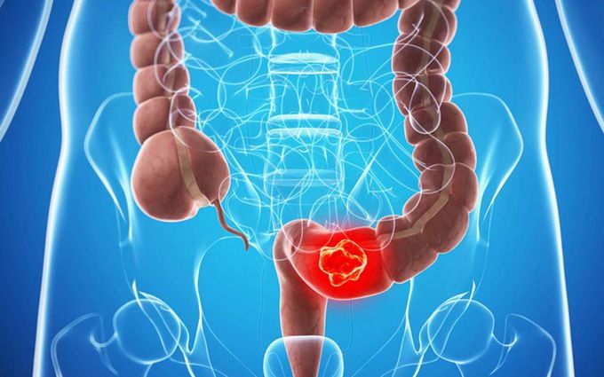Khám sức khỏe định kỳ giúp phát hiện các tổn thương tiền ung thư khi chưa có triệu chứng 