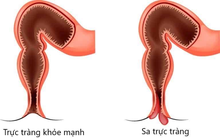 Da trực tràng là một bệnh lý gây nhiều khó khăn và đau đớn cho người bệnh.