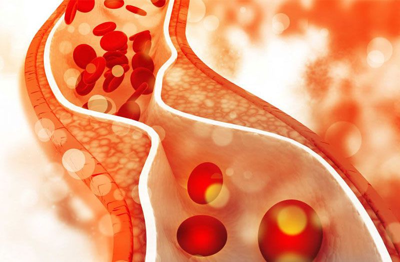 Các yếu tố như lối sống và di truyền đóng vai trò chính trong việc hình thành rối loạn lipid máu 