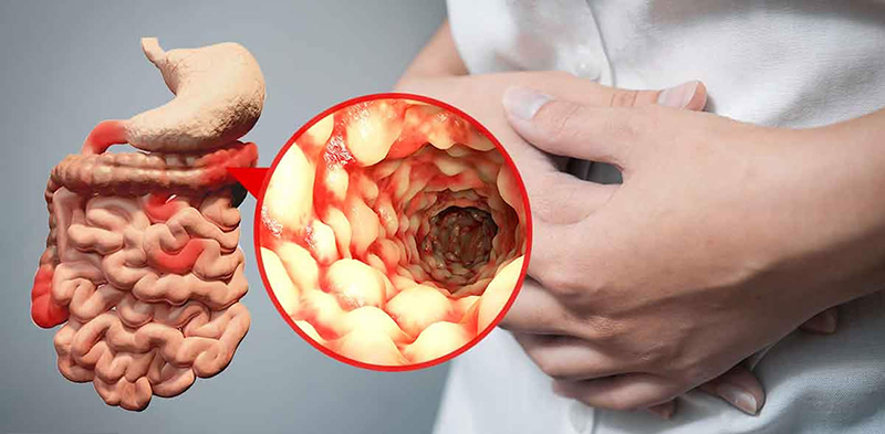 Một lối sống khoa học tránh xa bia rượu và thuốc lá giúp người bệnh Crohn sống khỏe mạnh và tự tin hơn
