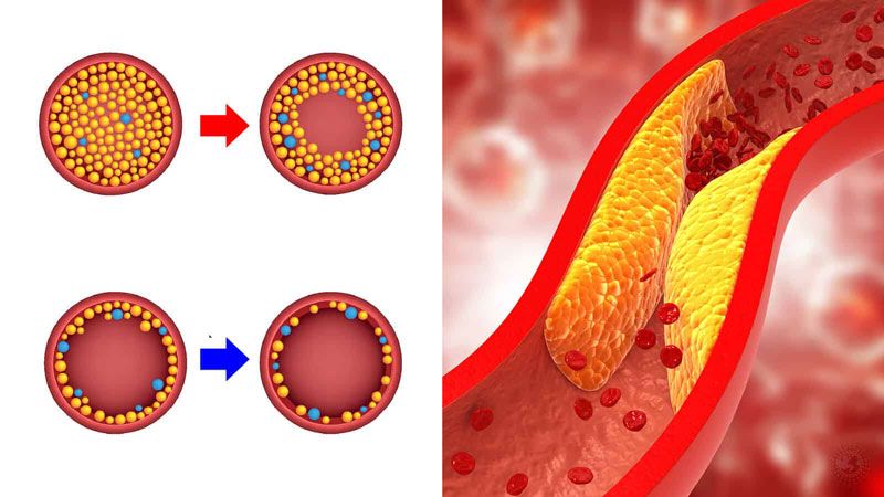 Tình trạng cholesterol máu cao kéo dài là nguyên nhân cốt lõi gây xơ vữa động mạch