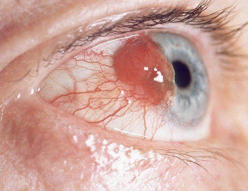 Dấu hiệu nhận biết ung thư mắt sớm 