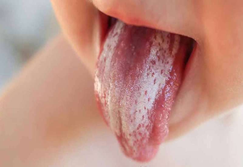 Trẻ sinh non thường nhiễm Candida ở lưỡi