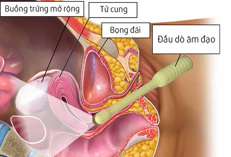 Chẩn đoán ung thư nội mạc tử cung như thế nào? 