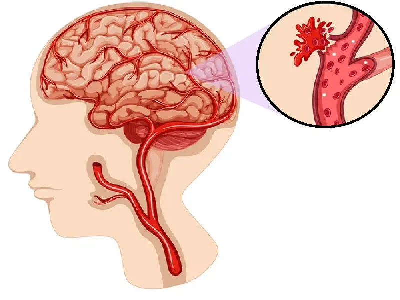 Phẫu thuật ngoại khoa được chỉ định nhằm giải phóng áp lực chèn ép nhu mô não