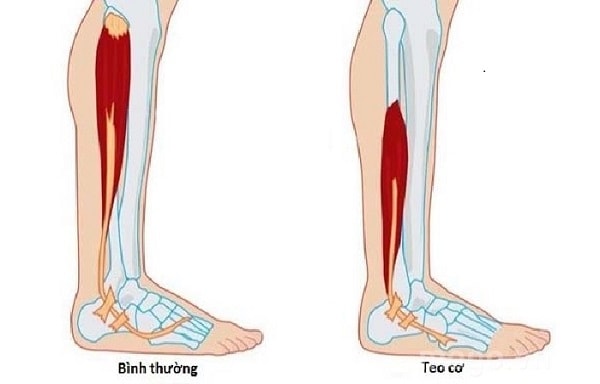 Tê tay, tê chân nếu không được điều trị kịp thời có thể dẫn đến biến chứng teo cơ